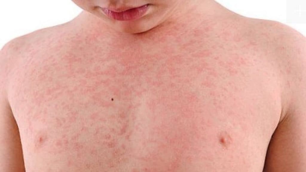 Imagen principal del artículo: Suben a 4 los casos confirmados de sarampión en familia estadounidense antivacunas
